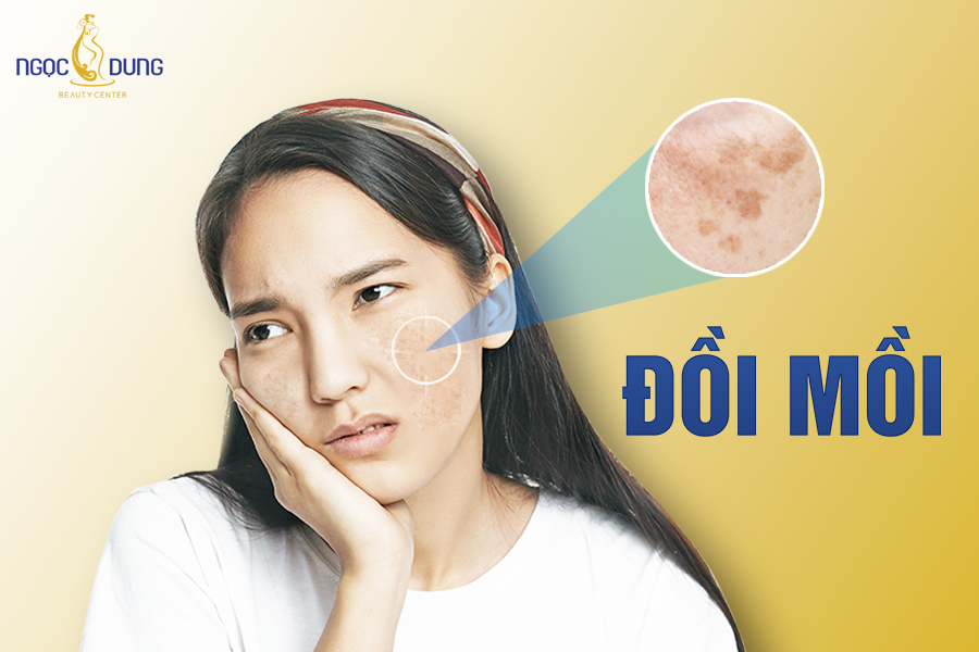 Đồi mồi là bệnh gì? Nguyên nhân gây ra đồi mồi