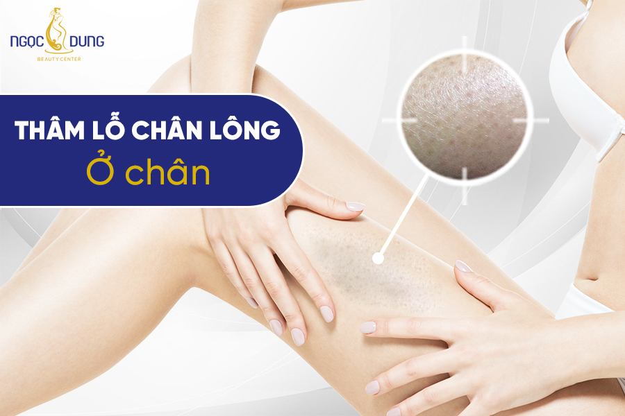 Bị thâm lỗ chân lông ở chân thì nên làm thế nào?