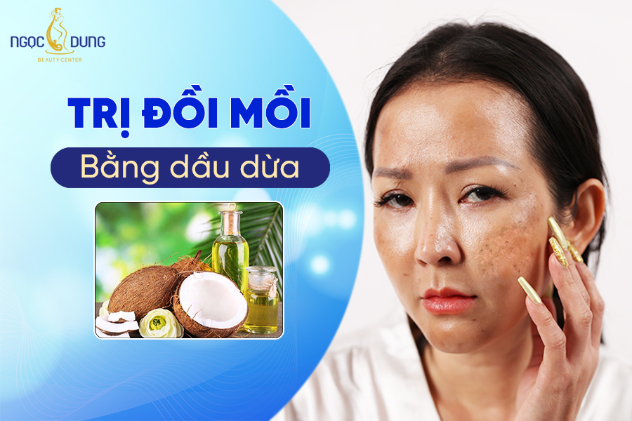 Trị đồi mồi bằng dầu dừa có tốt không?
