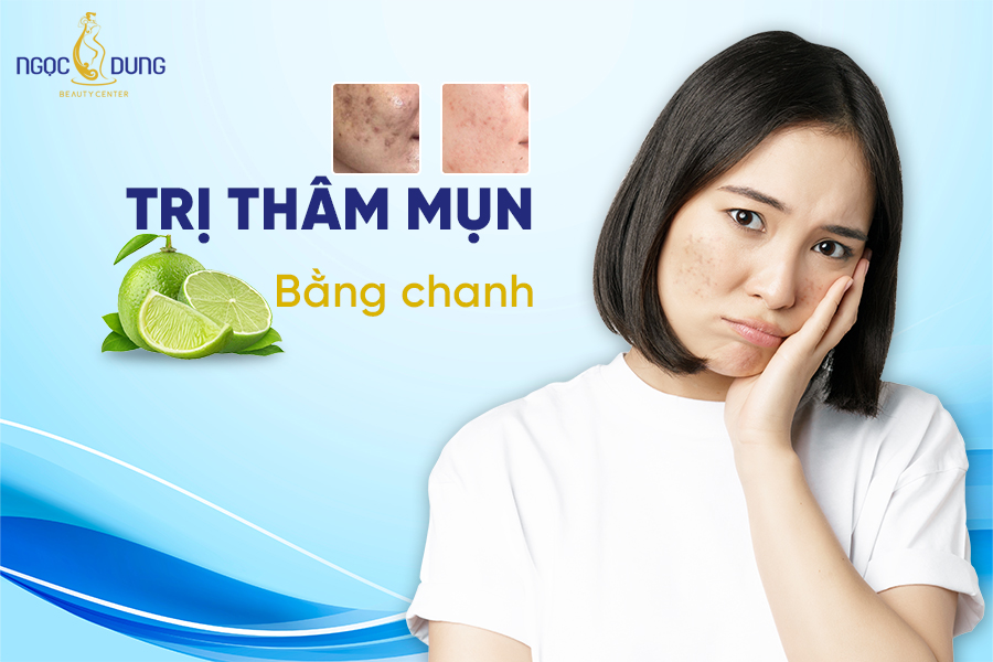 Có nên trị thâm mụn bằng chanh không?