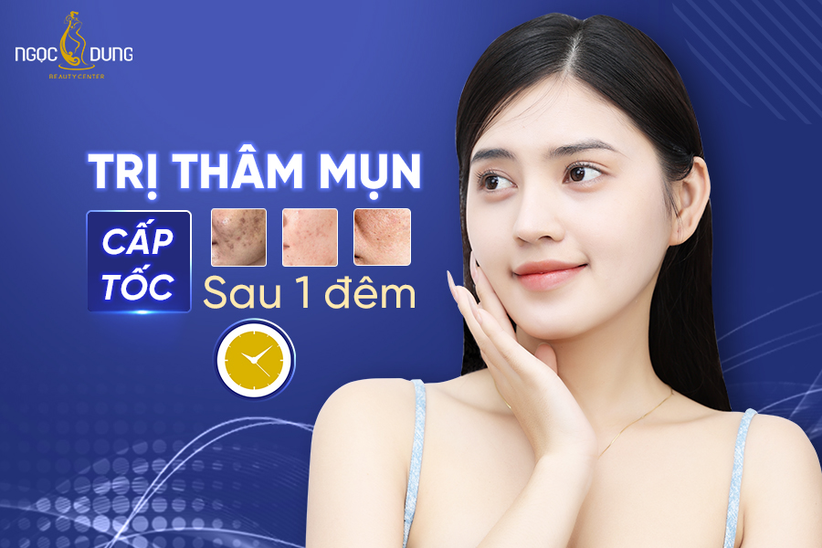 Bí quyết trị thâm mụn cấp tốc sau 1 đêm