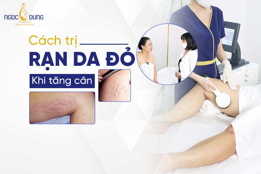 cách trị rạn da đỏ khi tăng cân