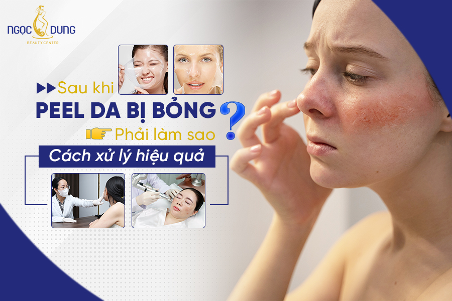 peel da bị bỏng