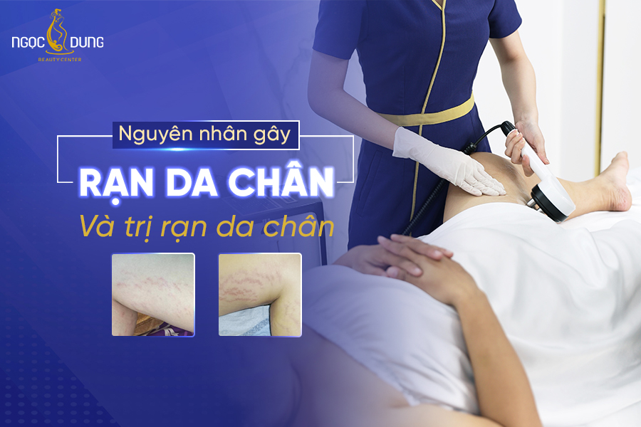rạn da chân