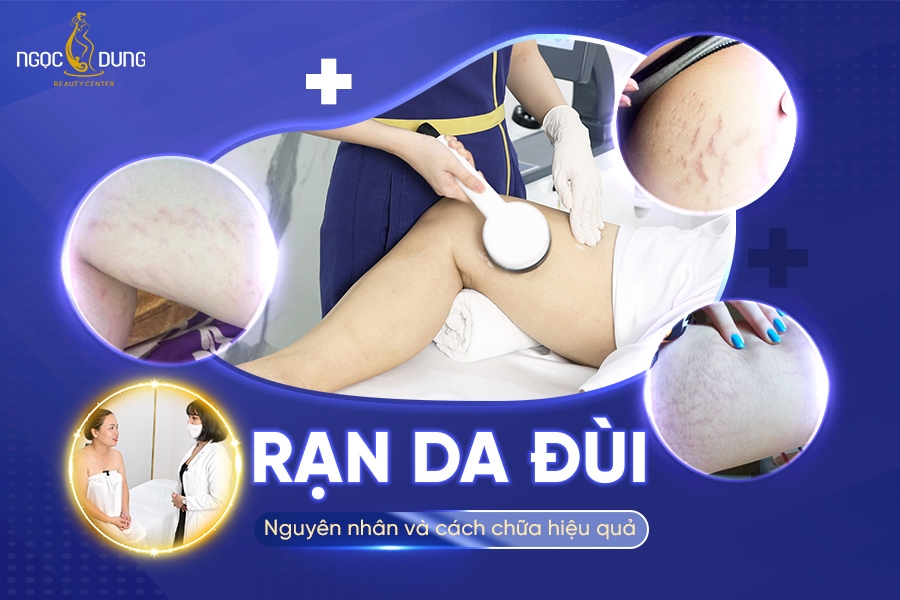 Rạn da đùi