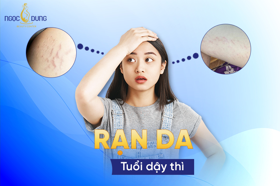 Rạn da tuổi dậy thì
