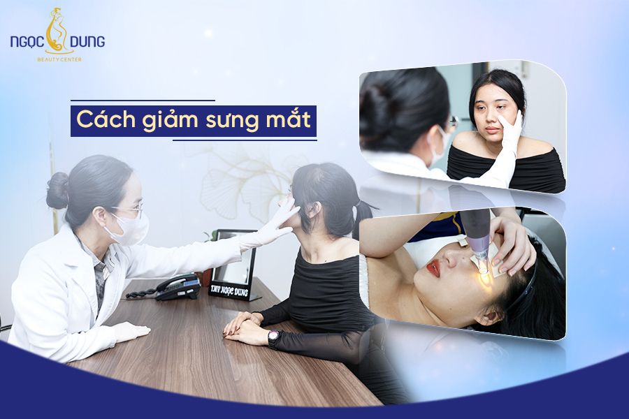 Tổng hợp các cách giảm sưng mắt đơn giản hiệu quả mà không phải ai cũng biết