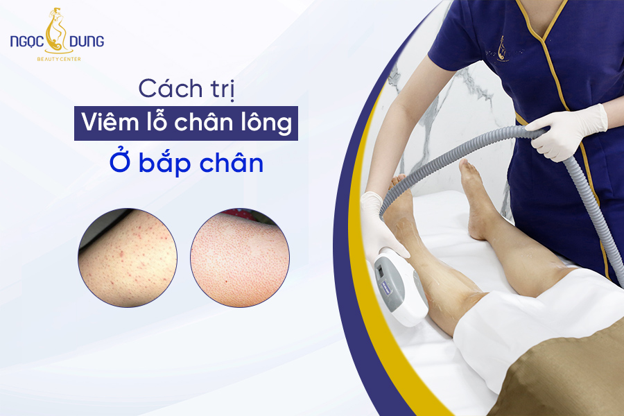 cách trị viêm lỗ chân lông ở bắp chân