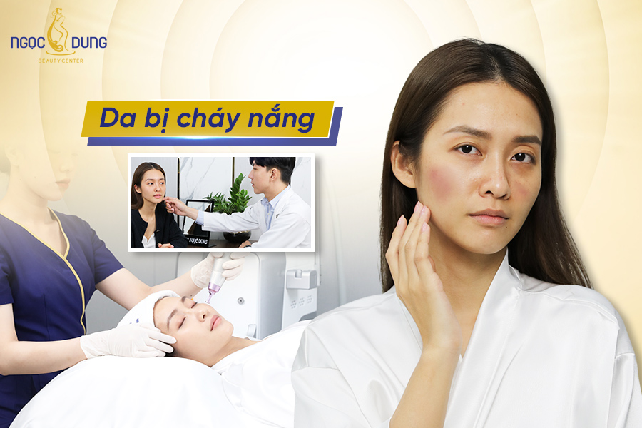 da bị cháy nắng