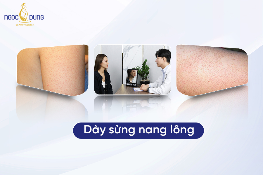 dày sừng nang lông