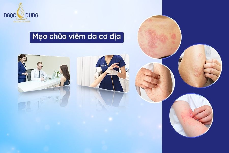 Tổng hợp các mẹo chữa viêm da cơ địa nhanh chóng, dễ thực hiện tại nhà cho chị em