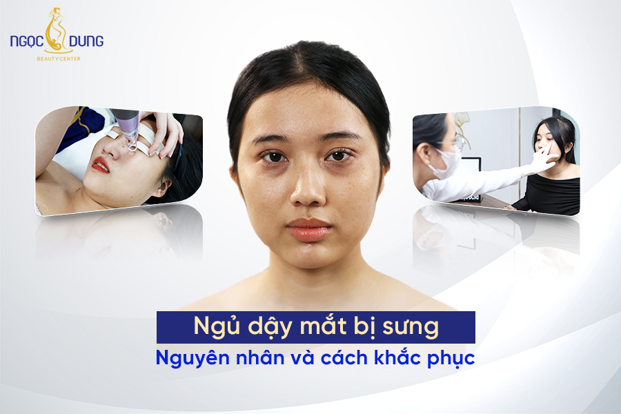 ngủ dậy mắt bị sưng