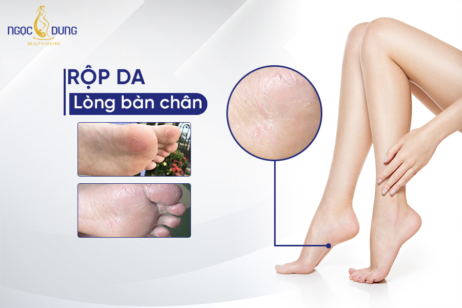 rộp da lòng bàn chân